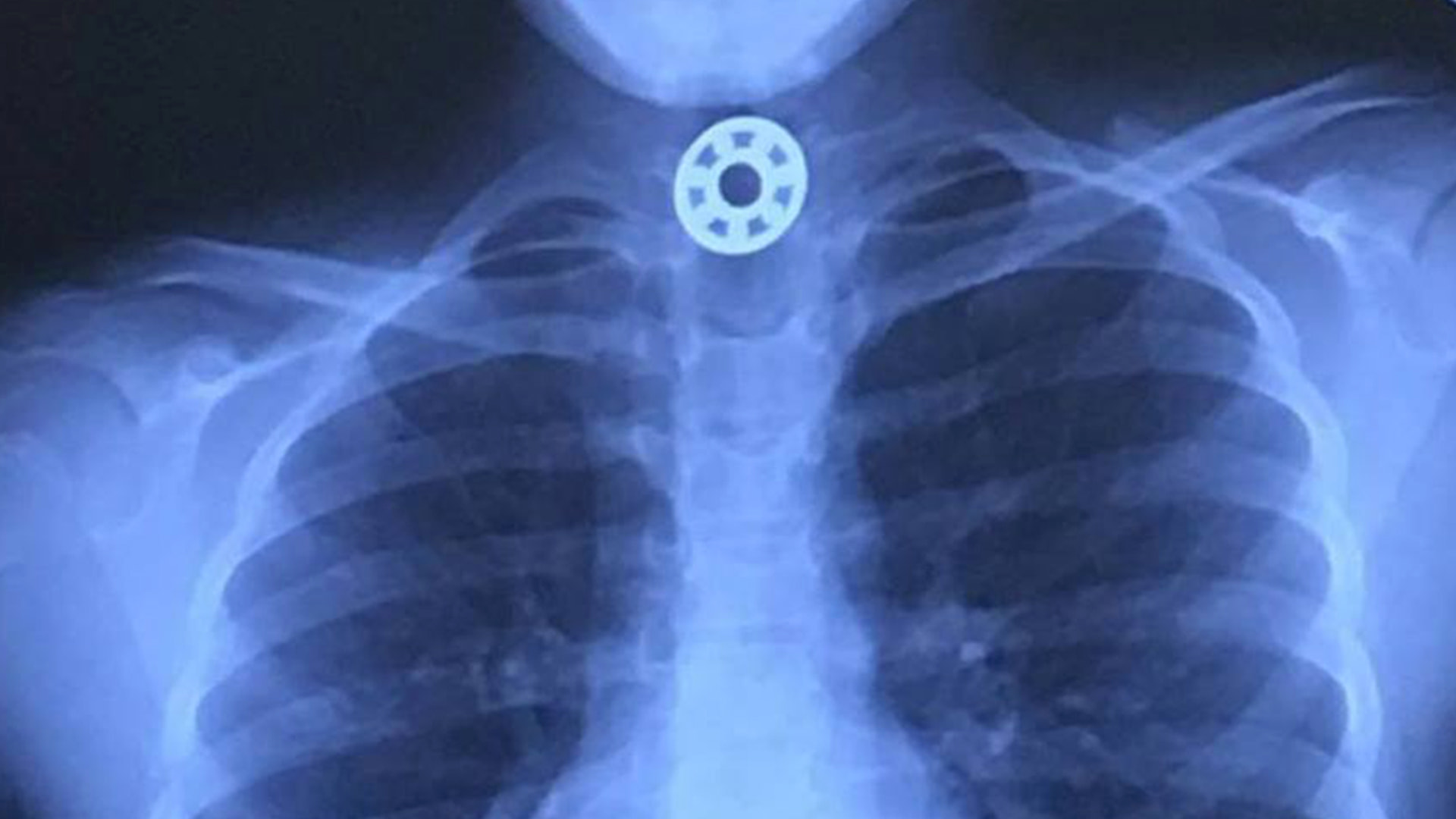 This Is Why You Shouldn't Let Your Kids Play With Fidget Spinners