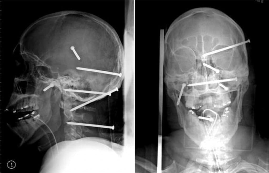 X,Ray Photos That Are 100,Percent Real As Well As 100